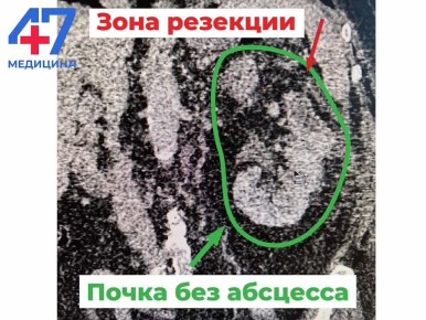 Врачи Всеволожской больницы смогли сохранить единственную почку пациентки