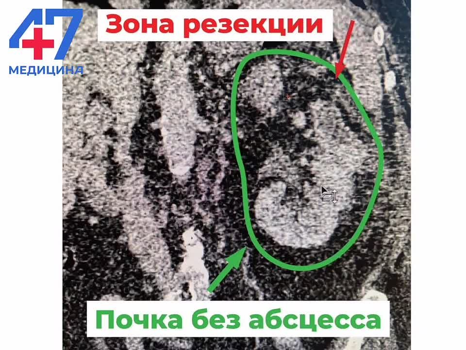 Врачи Всеволожской больницы смогли сохранить единственную почку пациентки