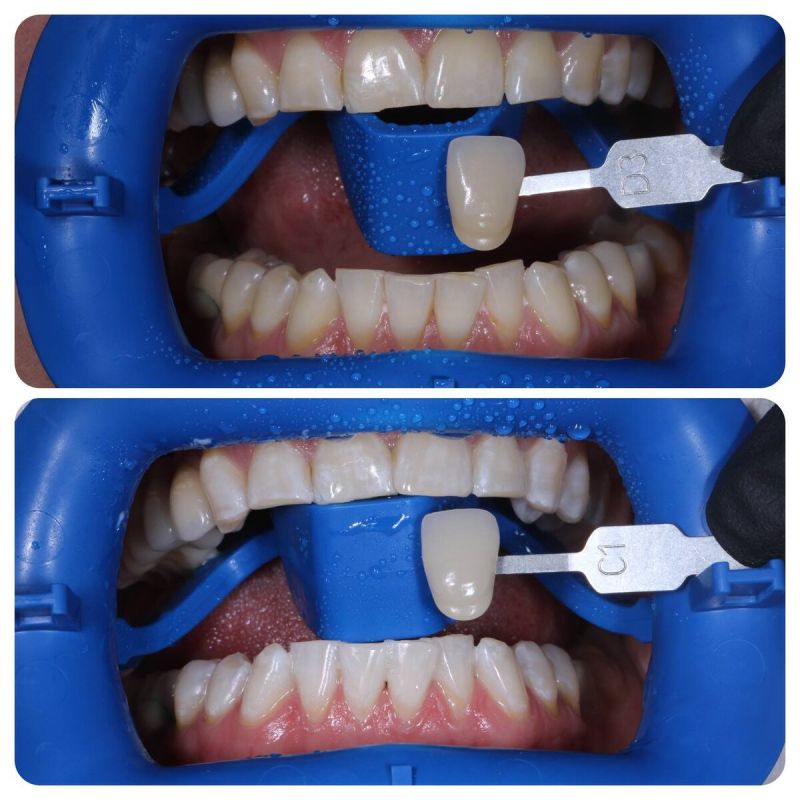 Опасный сосед: кариес и как его избежать